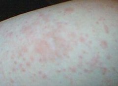 湿疹有哪些症状